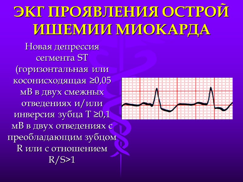 ЭКГ ПРОЯВЛЕНИЯ ОСТРОЙ ИШЕМИИ МИОКАРДА Новая депрессия сегмента ST (горизонтальная или косонисходящая ≥0,05 мВ